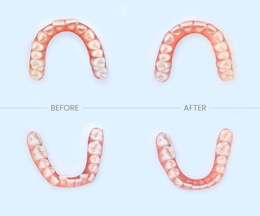 インビザライン治療前後のシュミレーション