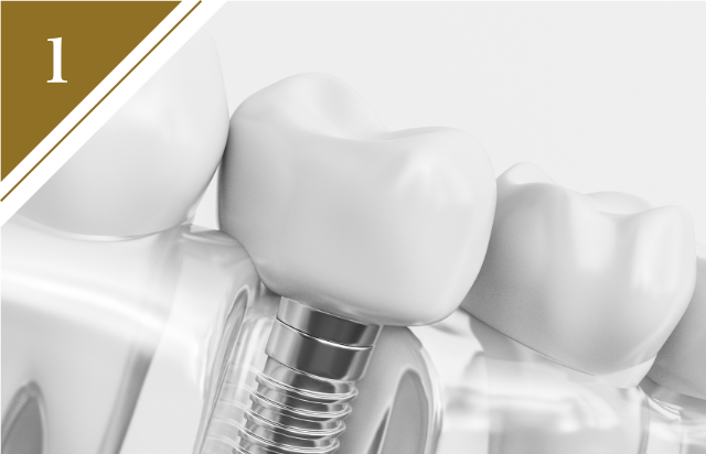 インプラント治療