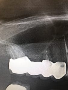 インプラント症例画像 【恵比寿の歯科・歯医者 さとうデンタルクリニック】