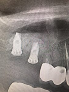 インプラント症例画像 【恵比寿の歯科・歯医者 さとうデンタルクリニック】