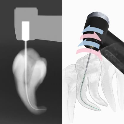 Tri AUTO ZX2を使用した根管形成のイメージ①