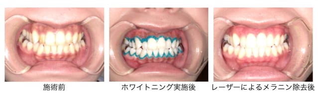 メラニン除去ビフォーアフター