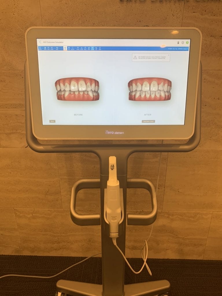 iTero(口腔内スキャナー)