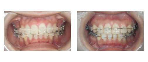 ホワイトワイヤー(左)とノーマルワイヤー(右)