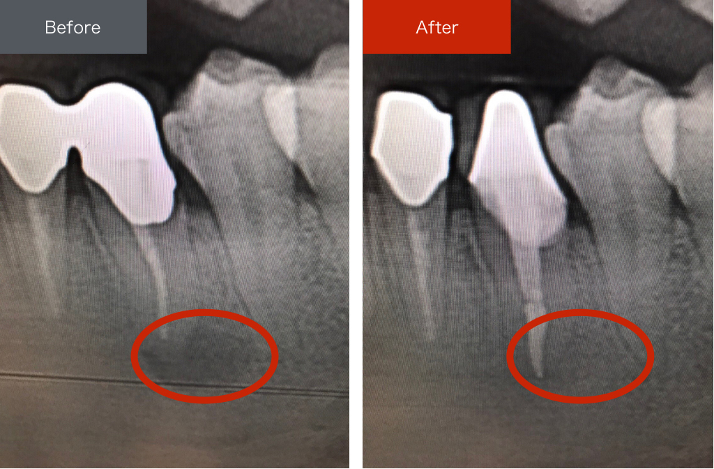 恵比寿の歯医者さとうデンタルクリニックの精密根管治療
