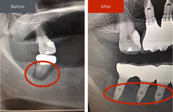 インプラント症例画像 【恵比寿の歯科・歯医者 さとうデンタルクリニック】