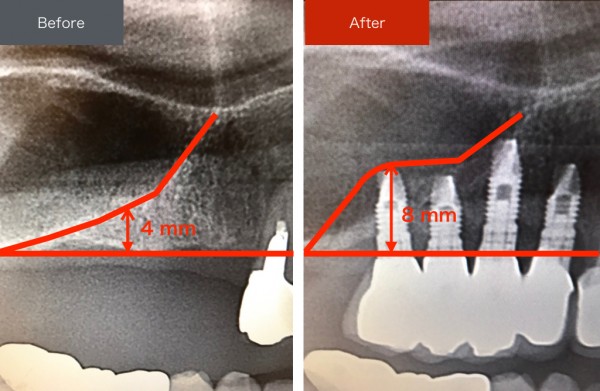 インプラント症例画像 【恵比寿の歯科・歯医者 さとうデンタルクリニック】