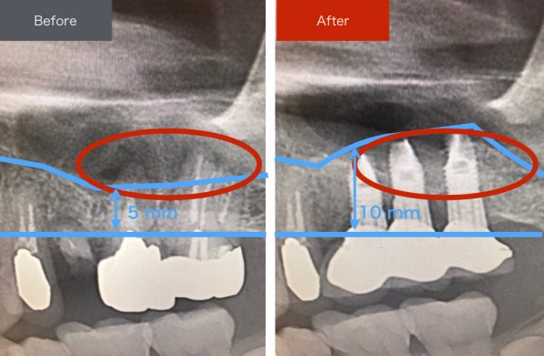 インプラント症例画像 【恵比寿の歯科・歯医者 さとうデンタルクリニック】