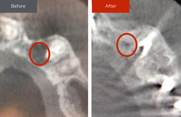 精密根管治療症例画像 【恵比寿の歯科・歯医者 さとうデンタルクリニック】