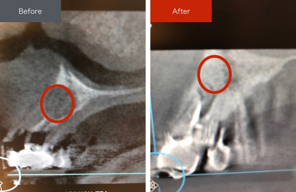 精密根管治療症例画像 【恵比寿の歯科・歯医者 さとうデンタルクリニック】