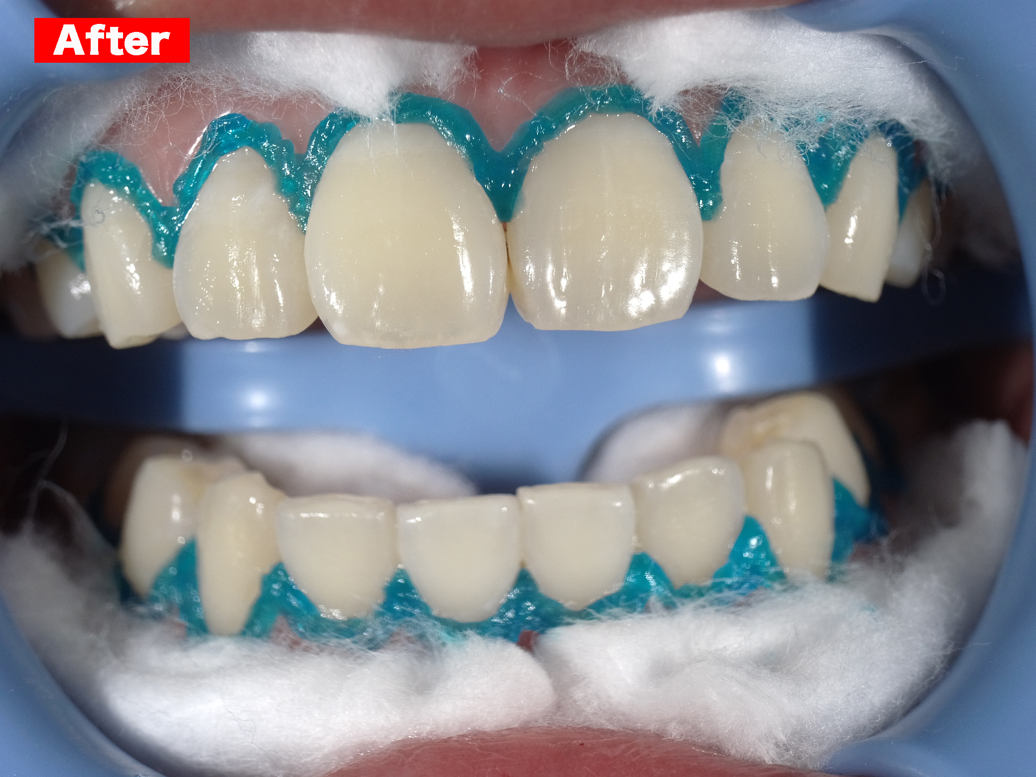 ホワイトニング症例画像 【恵比寿の歯科・歯医者 さとうデンタルクリニック】