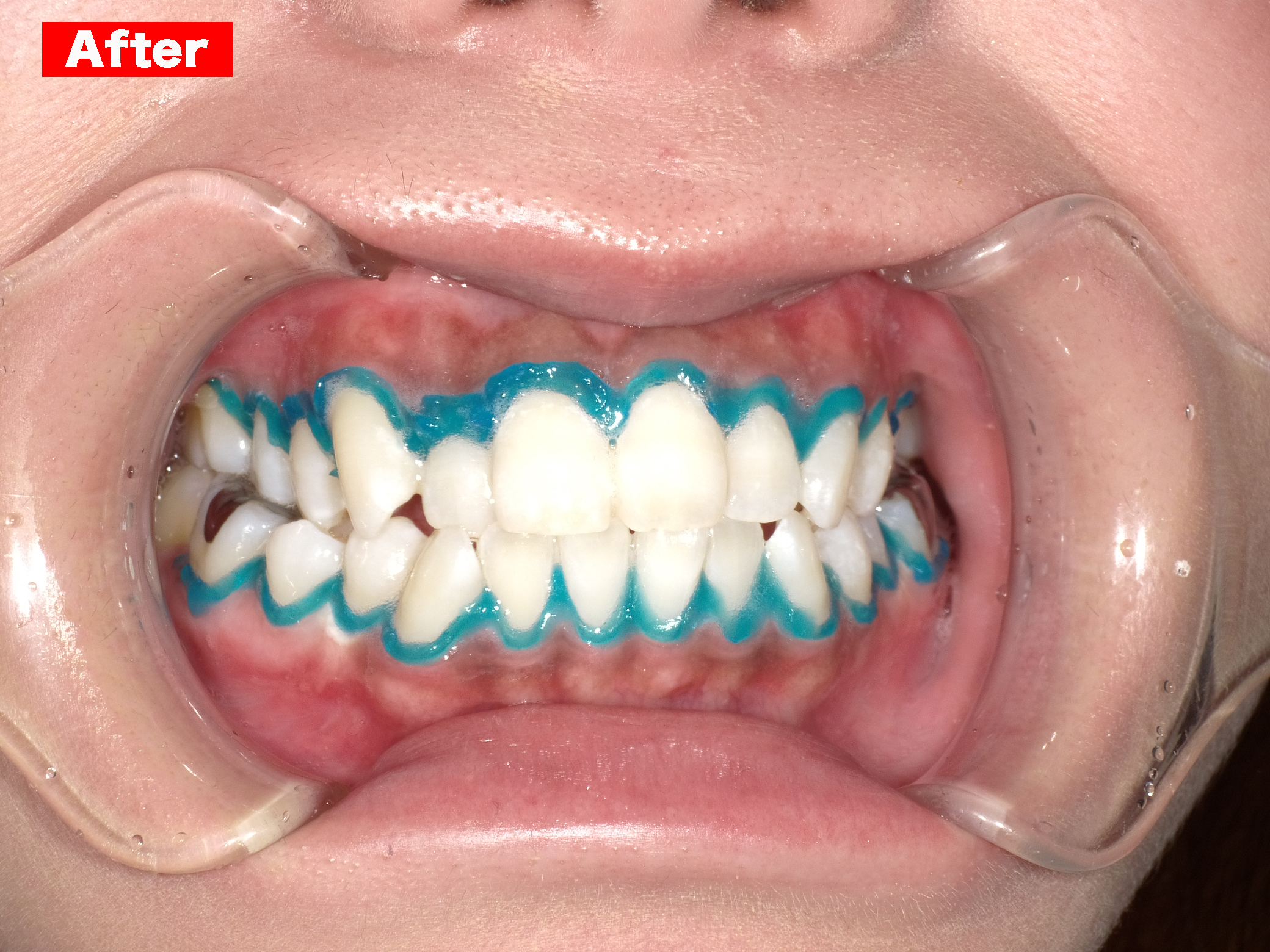 ホワイトニング症例画像 【恵比寿の歯科・歯医者 さとうデンタルクリニック】