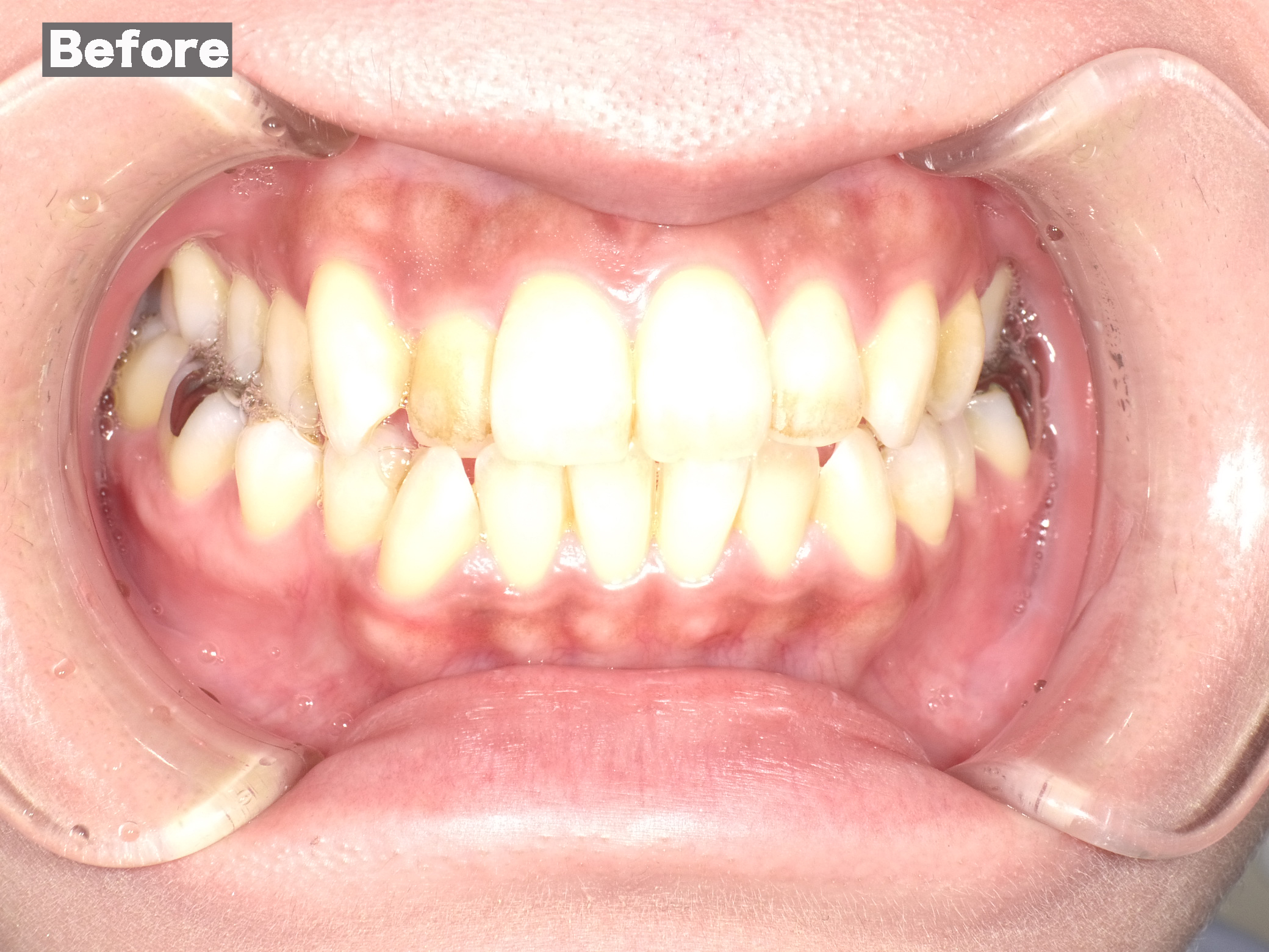 ホワイトニング症例画像 【恵比寿の歯科・歯医者 さとうデンタルクリニック】