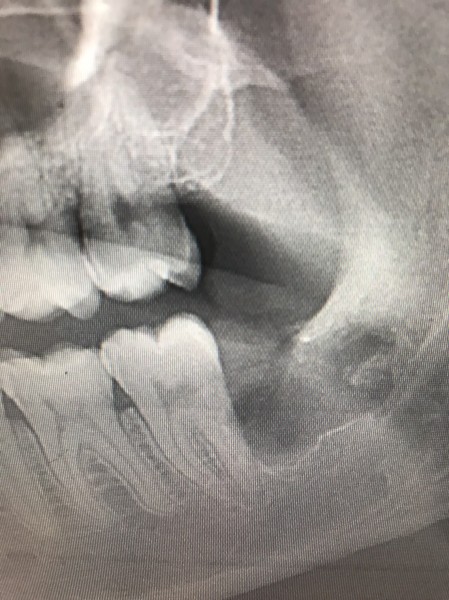 親知らず抜歯症例画像 【恵比寿の歯科・歯医者 さとうデンタルクリニック】