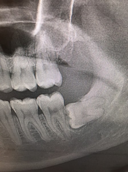 親知らず抜歯症例画像 【恵比寿の歯科・歯医者 さとうデンタルクリニック】