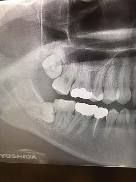 親知らず抜歯症例画像 【恵比寿の歯科・歯医者 さとうデンタルクリニック】
