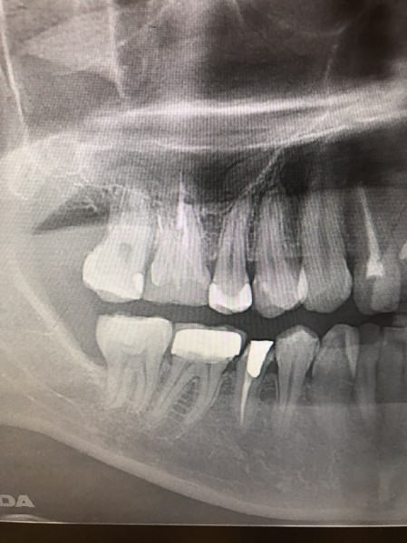 親知らず抜歯症例画像 【恵比寿の歯科・歯医者 さとうデンタルクリニック】