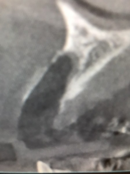 インプラント症例画像 【恵比寿の歯科・歯医者 さとうデンタルクリニック】