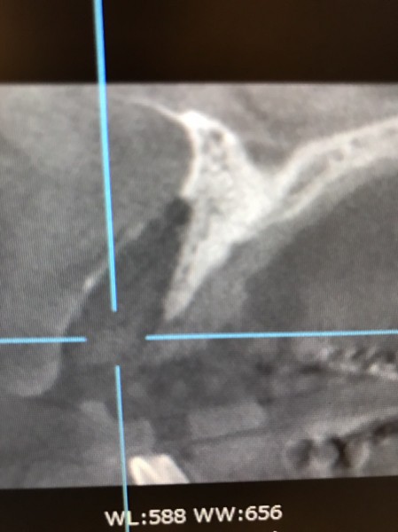 インプラント症例画像 【恵比寿の歯科・歯医者 さとうデンタルクリニック】