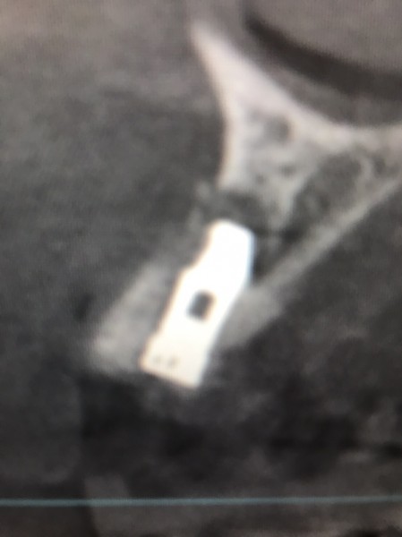 インプラント症例画像 【恵比寿の歯科・歯医者 さとうデンタルクリニック】