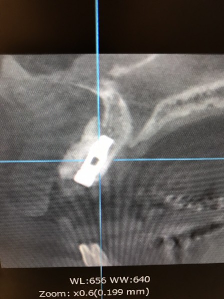 インプラント症例画像 【恵比寿の歯科・歯医者 さとうデンタルクリニック】